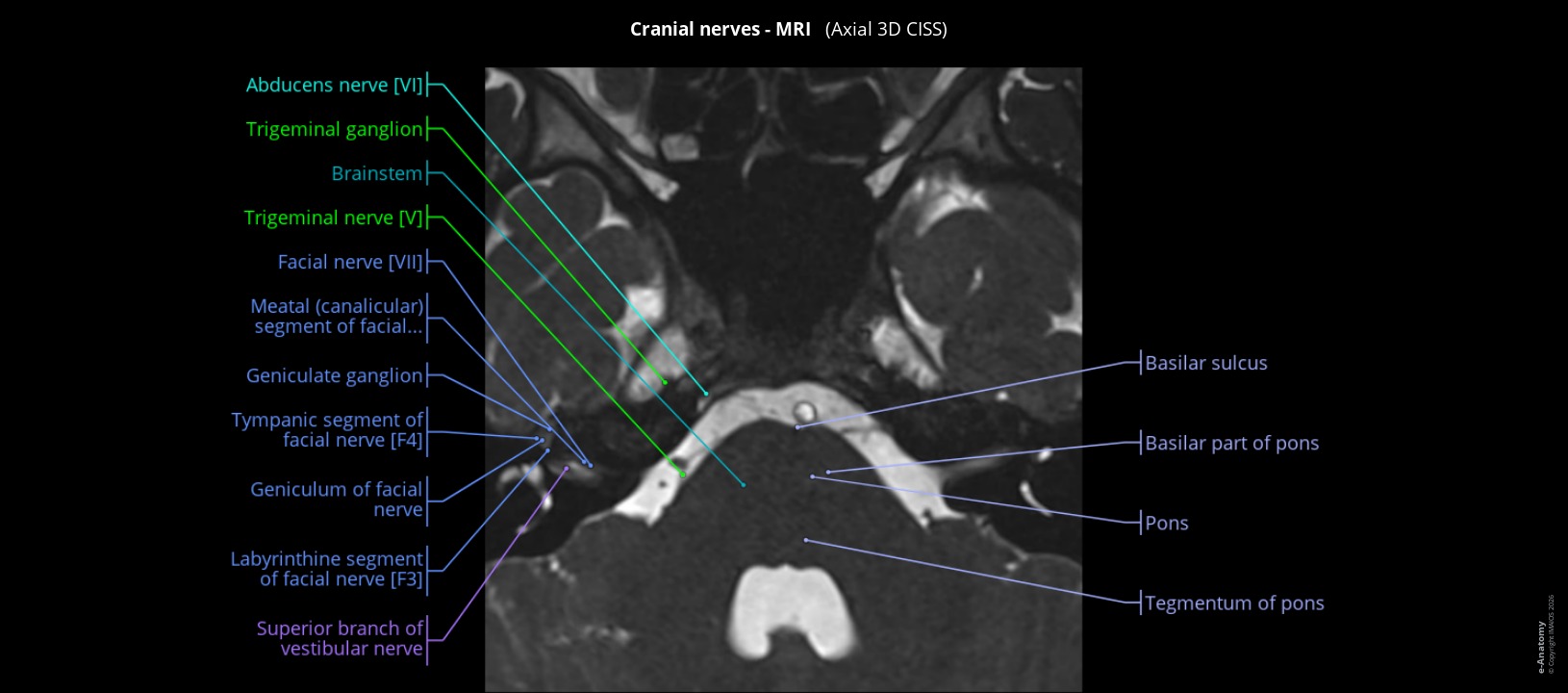 Labeled MRI of the cranial nerves in humans: axial 3D CISS section
