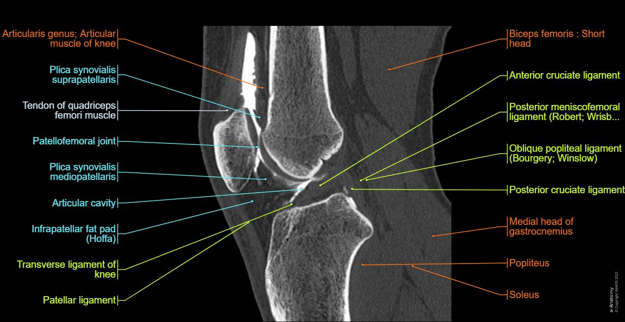 Radiological anatomy of the knee on a CT Arthrogram: Anterior cruciate ligament, Plica synovialis suprapatellaris