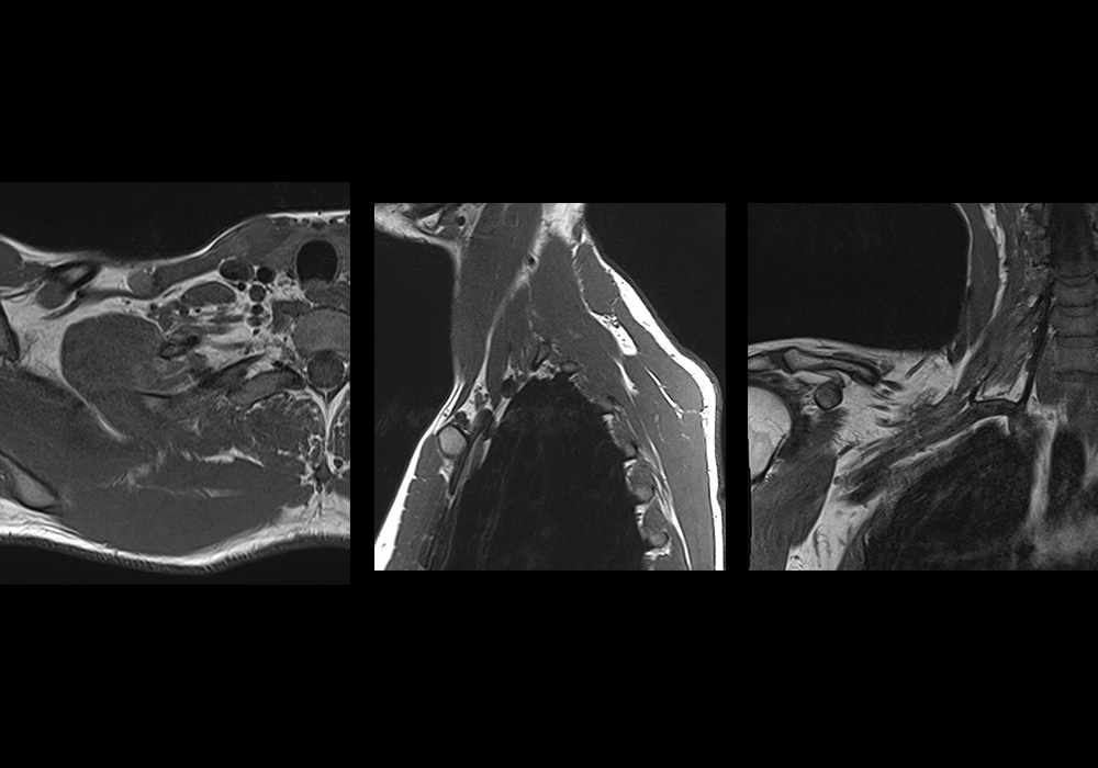 Anatomy of the brachial plexus on MR imaging (thoracic outlet, pectoral girdle, and axillary fossa)