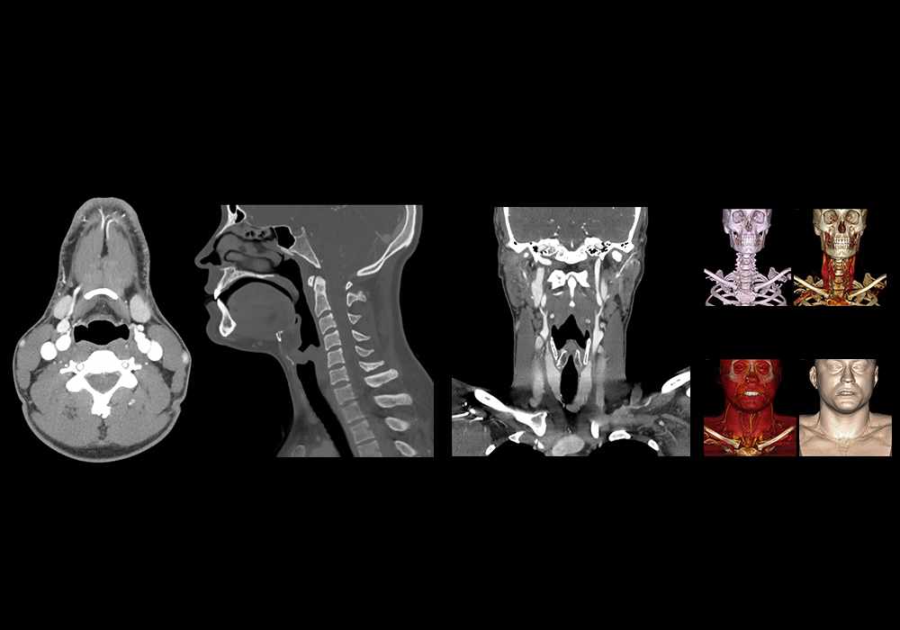 Anatomy of the head and neck (CT Scan)