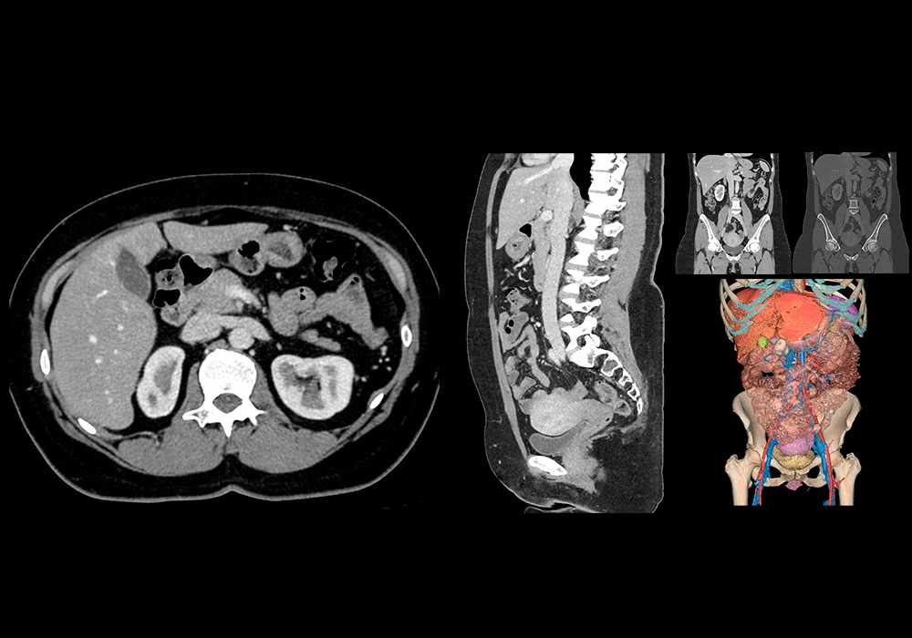 Normal CT abdomen and pelvis - female