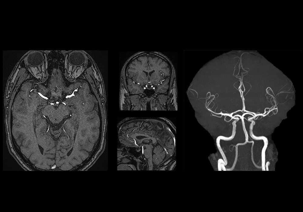 Anatomy of arteries of the brain and circle of Willis on a TOF MRA