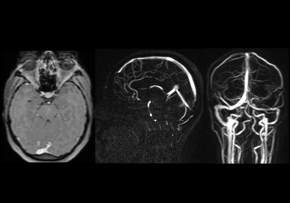 MR cerebral venography: normal exam on Phase-contrast MRV