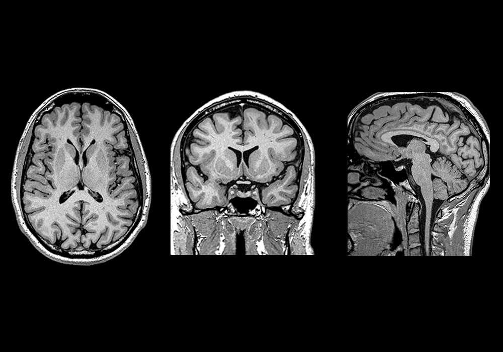 Brain MRI 3D: normal anatomy | e-Anatomy
