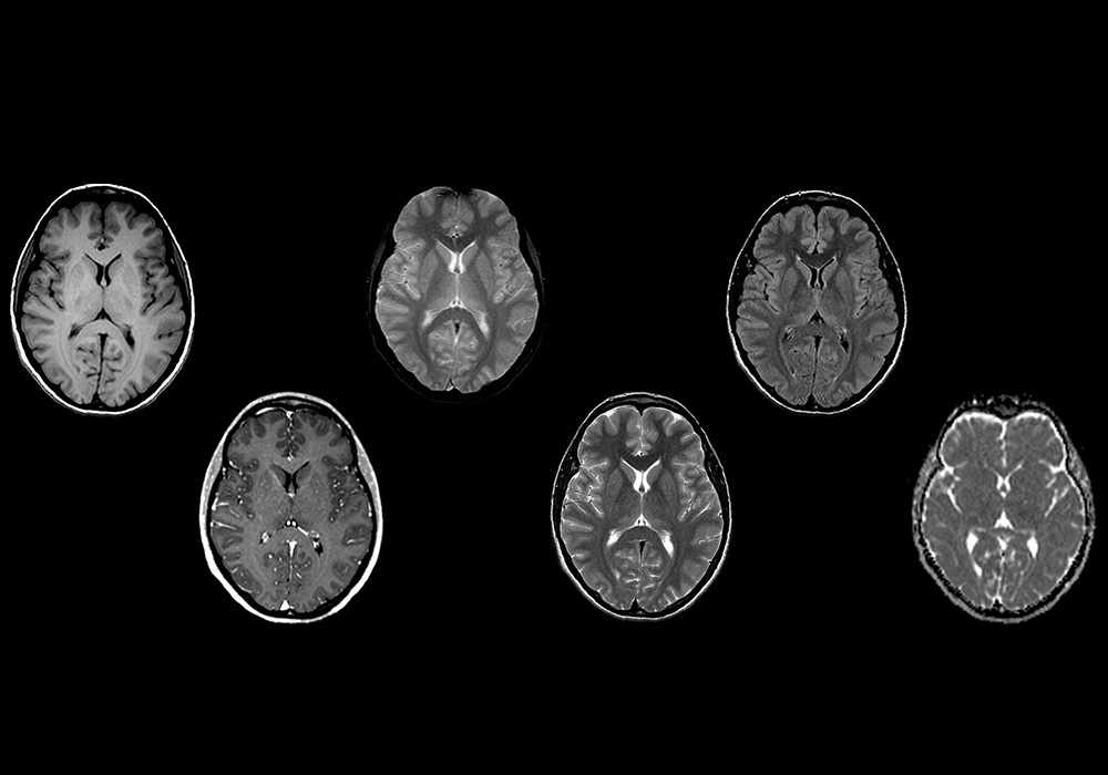 Anatomy of the encephalon (MRI) in axial slices