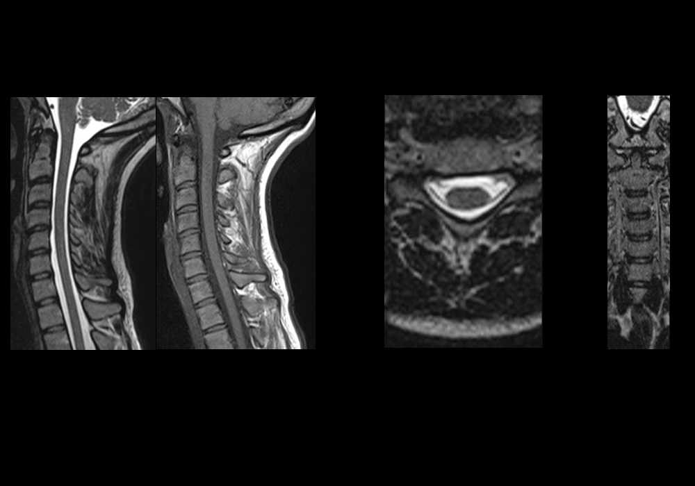 Normal anatomy of the Cervical spine, cervical vertebrae, spinal cord, ligaments and joints
