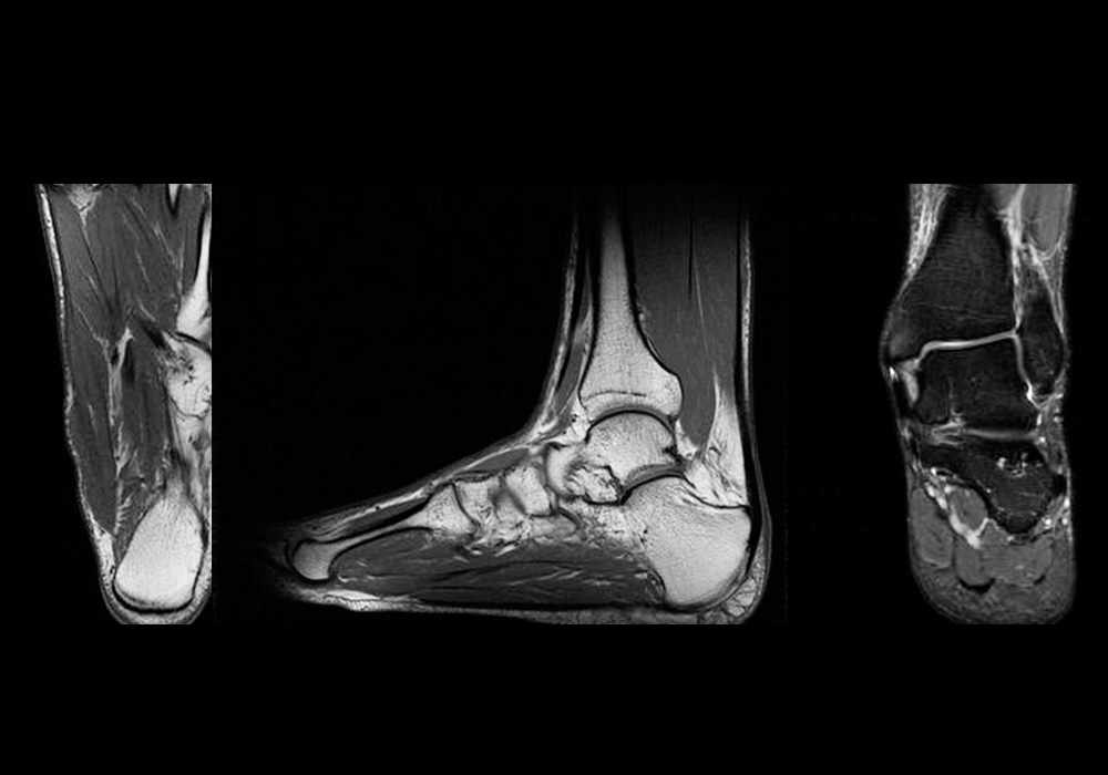Anatomy of the ankle and foot (MRI) - atlas of the human body using cross-sectional imaging