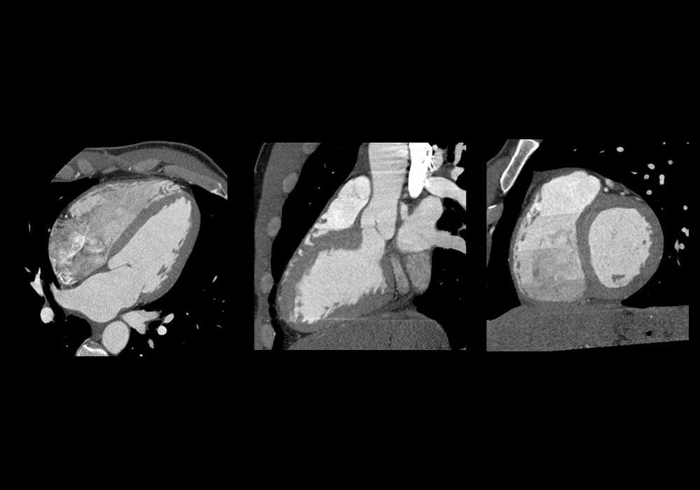 Anatomy of the heart - Interactive atlas of the human body using cross-sectional imaging