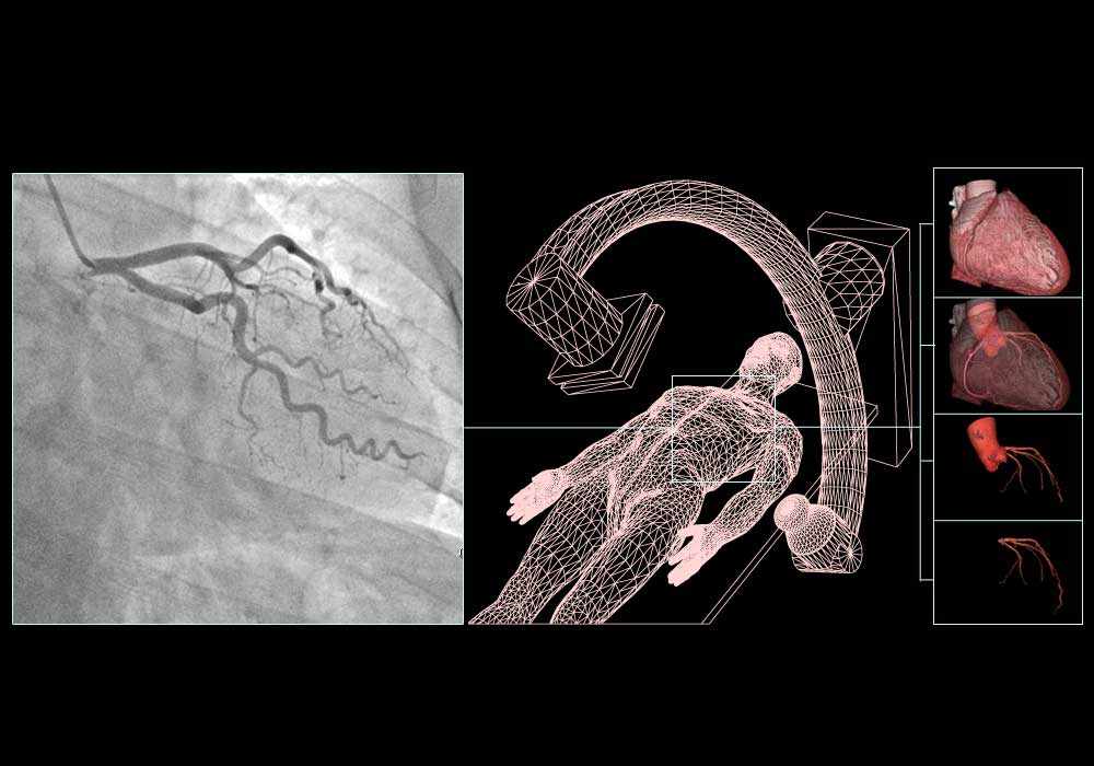 Radiological anatomy of the coronary arteries after cardiac catheterisation