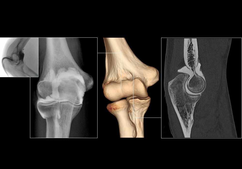 Radiographic anatomy of the elbow on a CT arthrogram