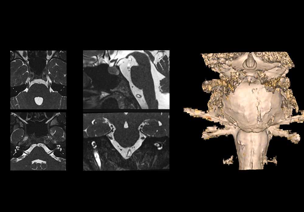 Imaging of cranial nerves and brainstem: normal 3D CISS MR of cerebral fossa