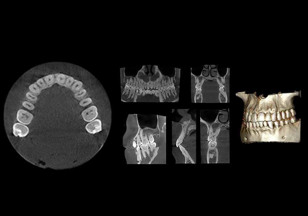 Normal dental Cone Beam Computed Tomography (CBCT)