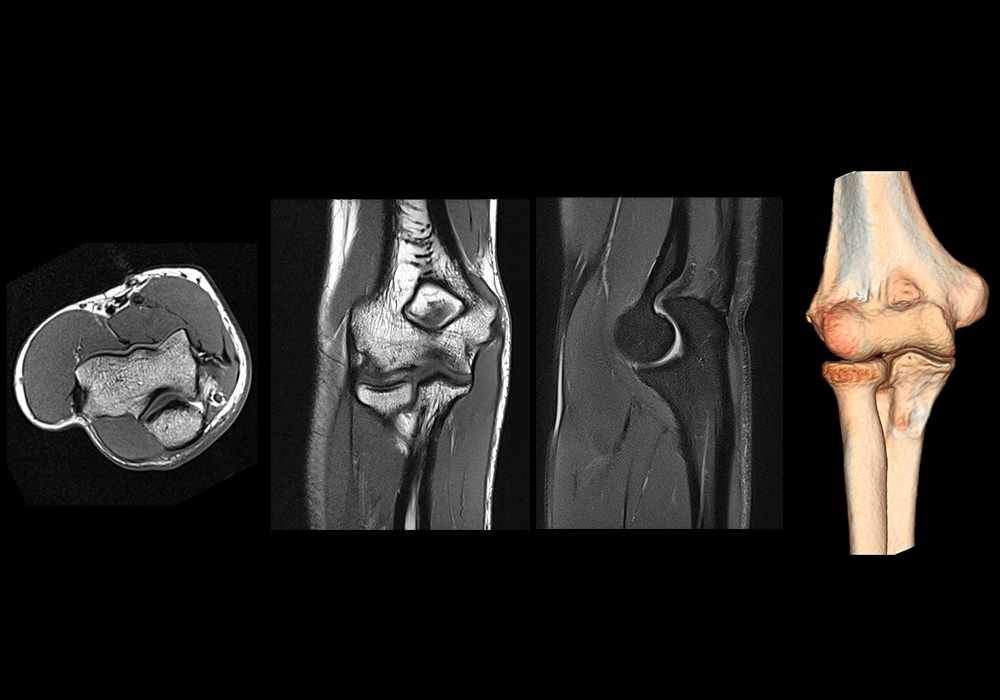 Anatomy of the elbow (MR cross-sectional imaging and 3D medical pictures)