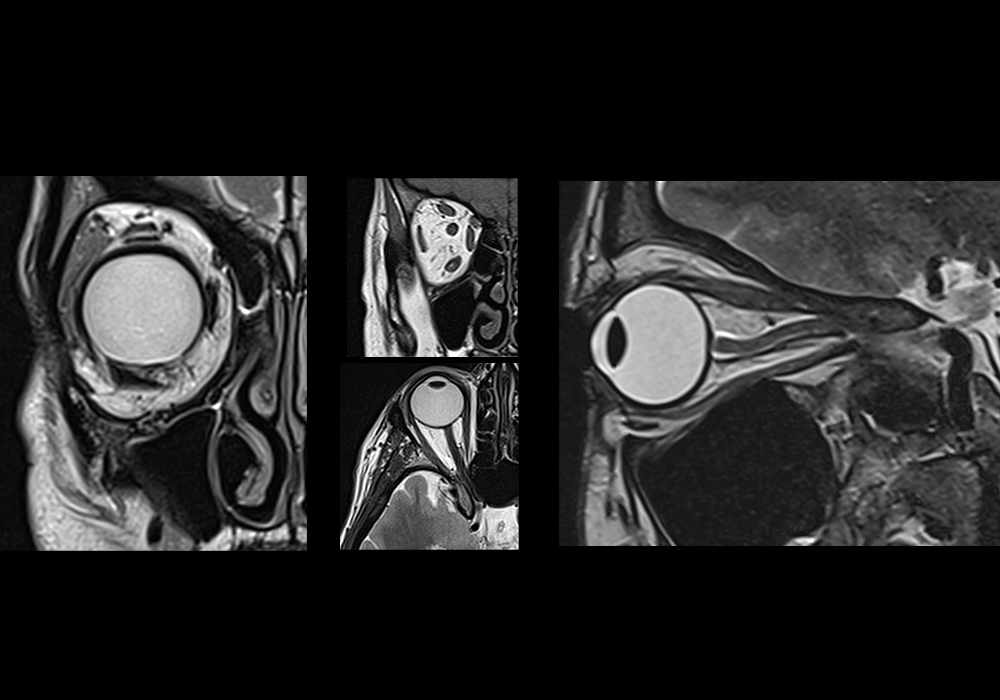 Normal MRI of the orbits