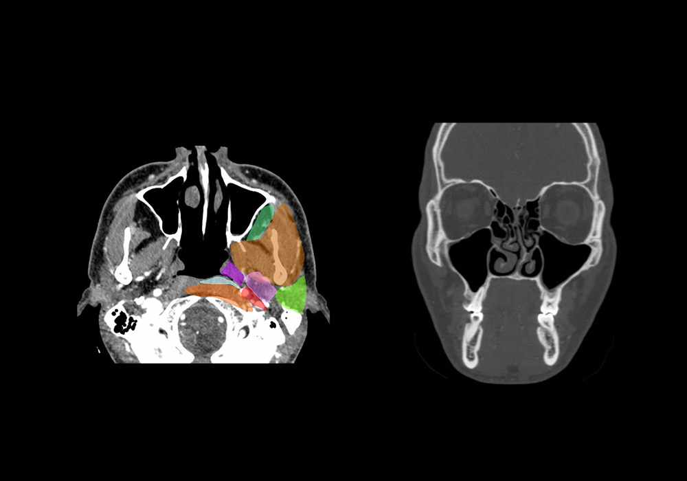 Anatomy of the face and neck (CT) - interactive atlas of human anatomy using cross-sectional imaging