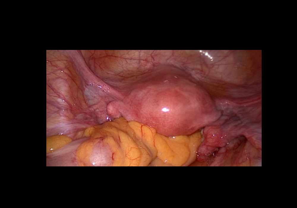 Laparoscopic anatomy of the female pelvic region