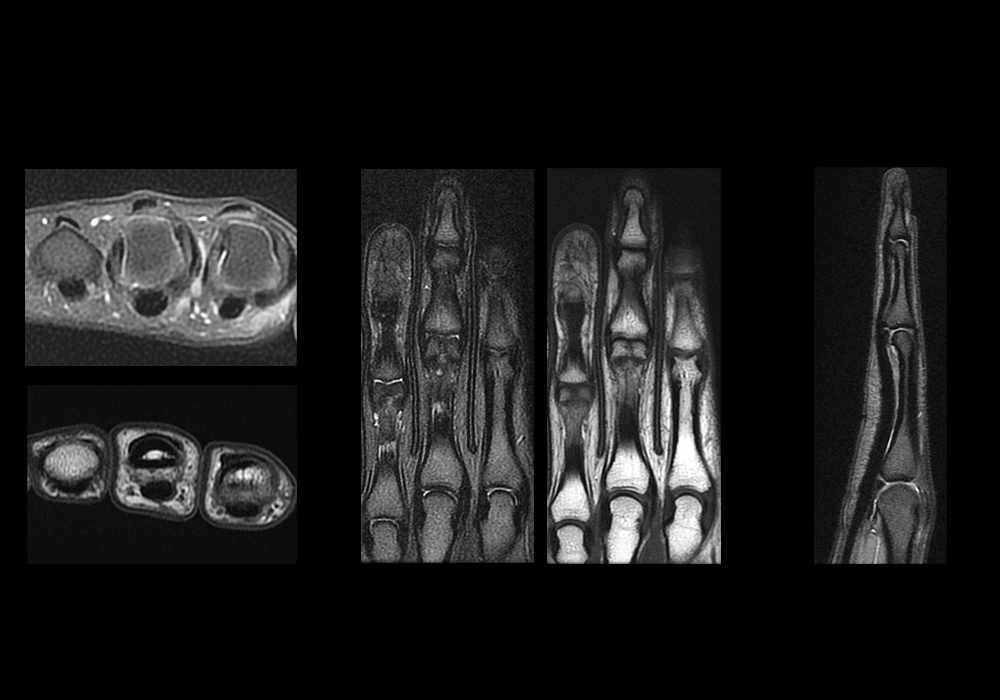 手指正常MRI