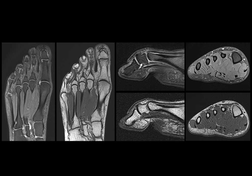 Normal MRI of the forefoot