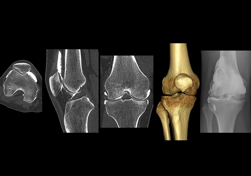 CT arthrogram of the knee joint