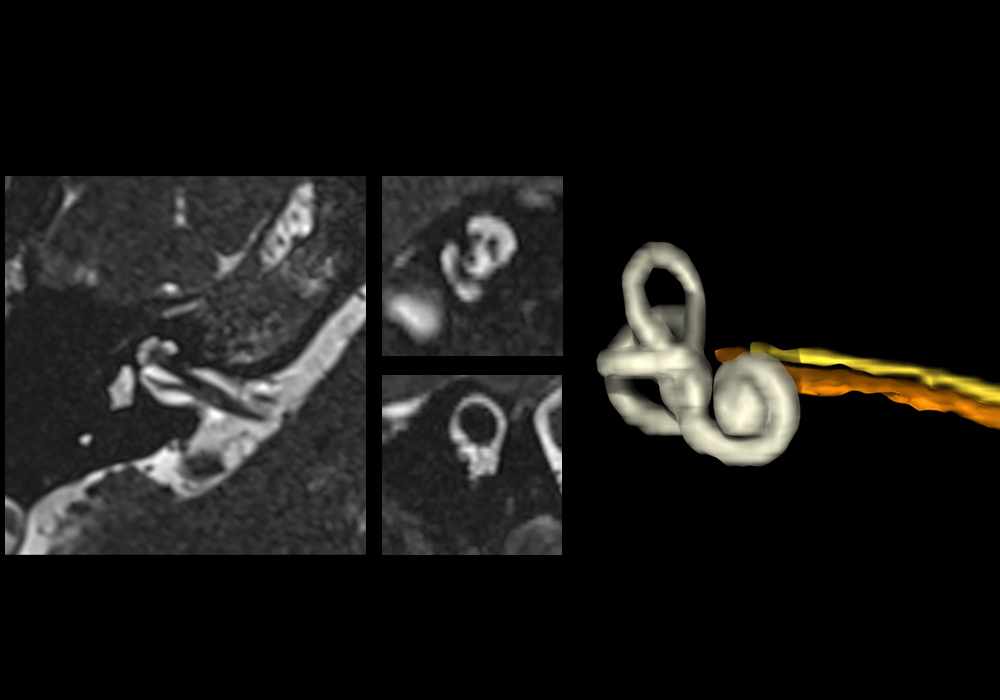 Normal MRI of inner ear and internal auditory canal