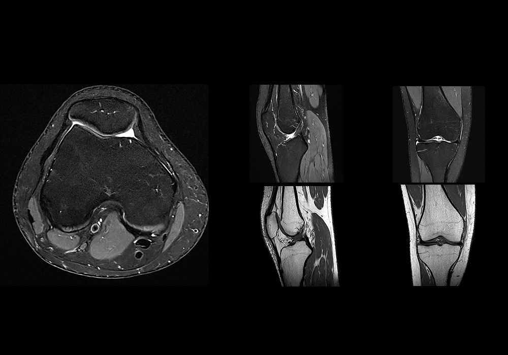 Normal MRI of the knee
