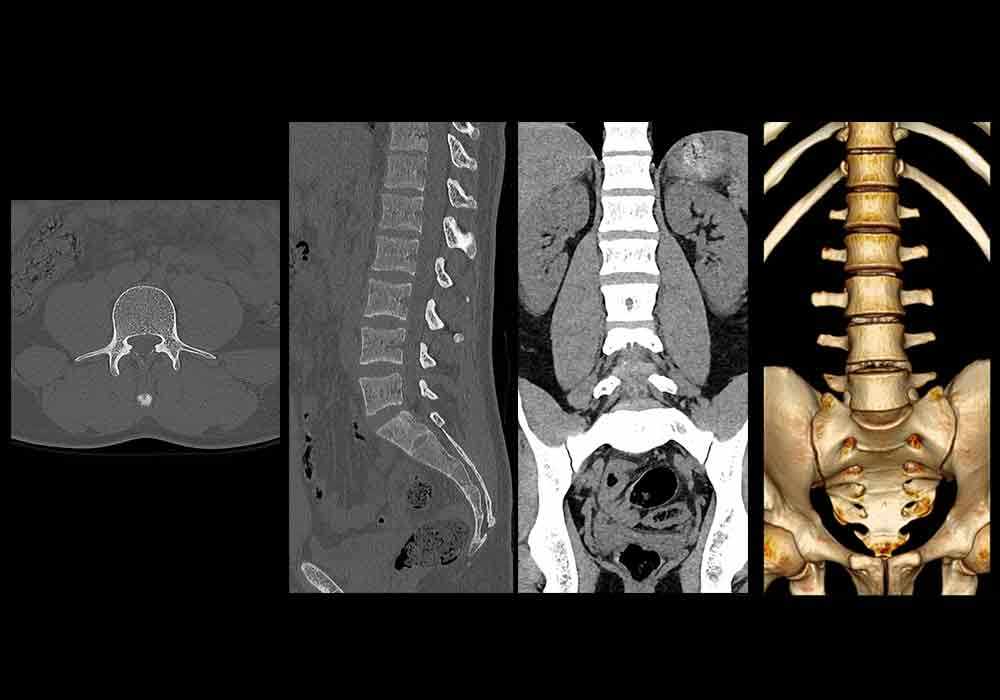 Anatomy of the lumbar spine
