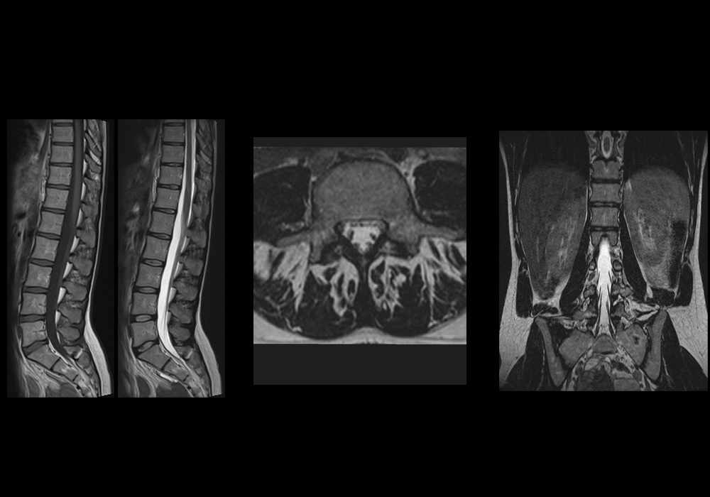 Anatomy of the lumbar vertebrae (cross-sectional imaging on T1, T2 and 3D MR)