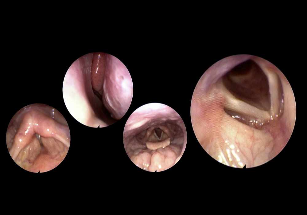 Normal examination respiratory system by endoscopy: nasoendoscopy
