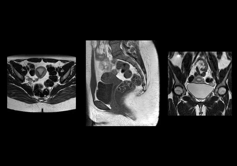 Anatomy of the female pelvis - Atlas of the human body using cross-sectional imaging