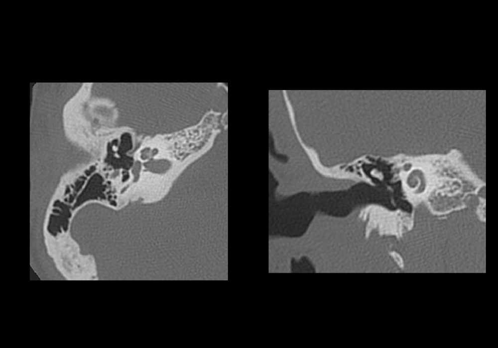 Petrous part of the temporal bone on a CT Scan: normal anatomy