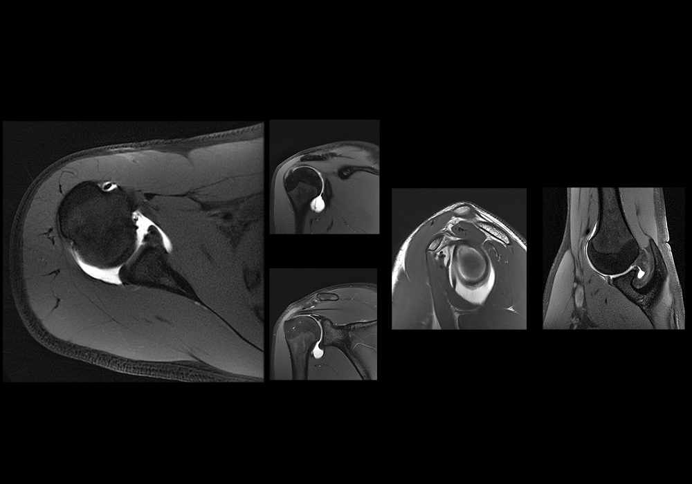 Shoulder MR Arthrogram | e-Anatomy