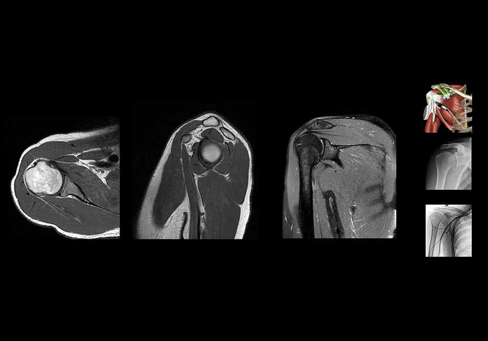 Shoulder MRI: normal anatomy | e-Anatomy