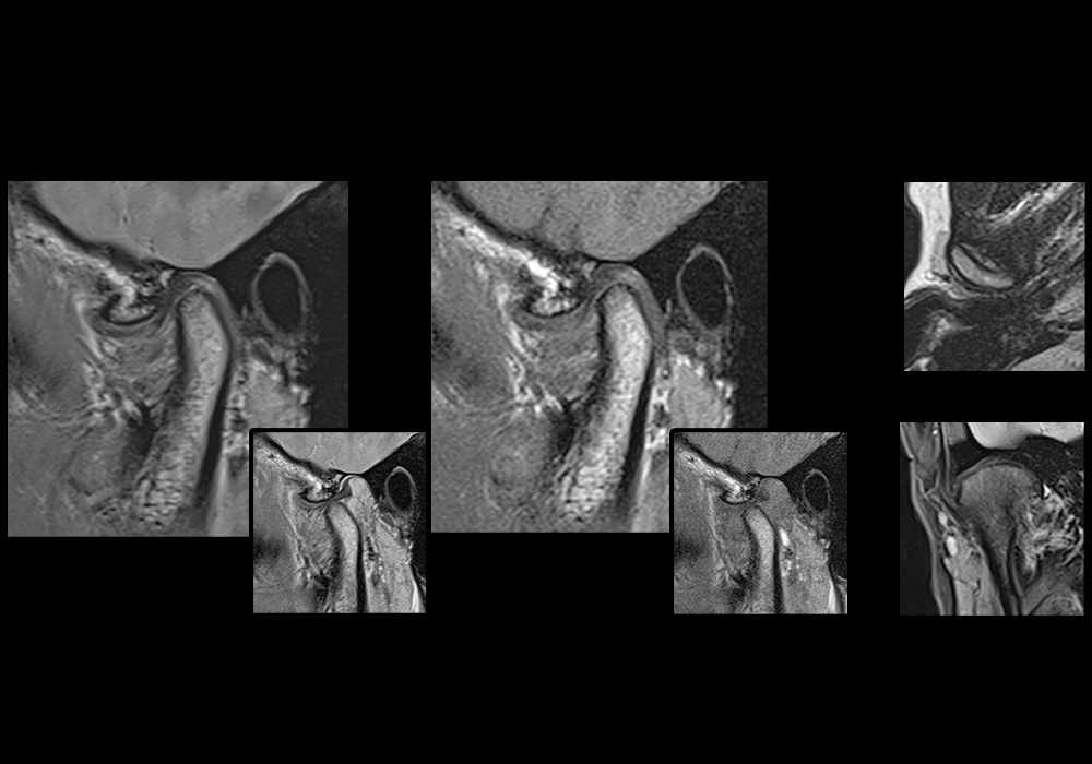 MR Imaging of the temporomandibular joint (TMJ): normal exam in closed/open-mouth and dynamic sequences