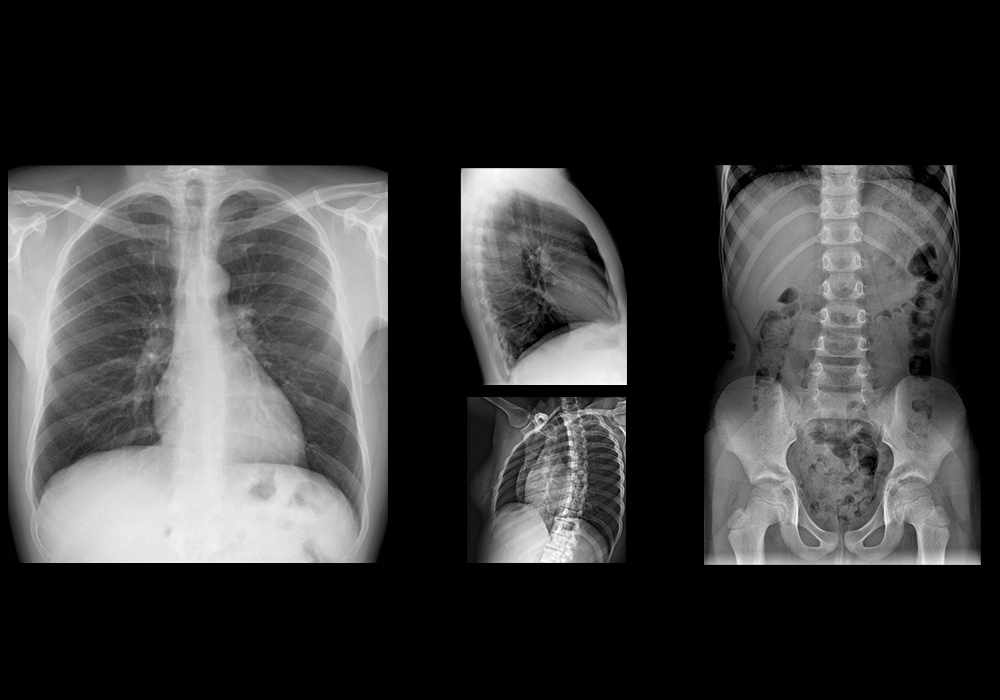Normal chest X-Ray and abdomen radiographs