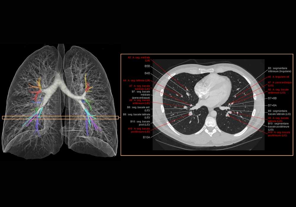 Normal thoracic CT in axial slice