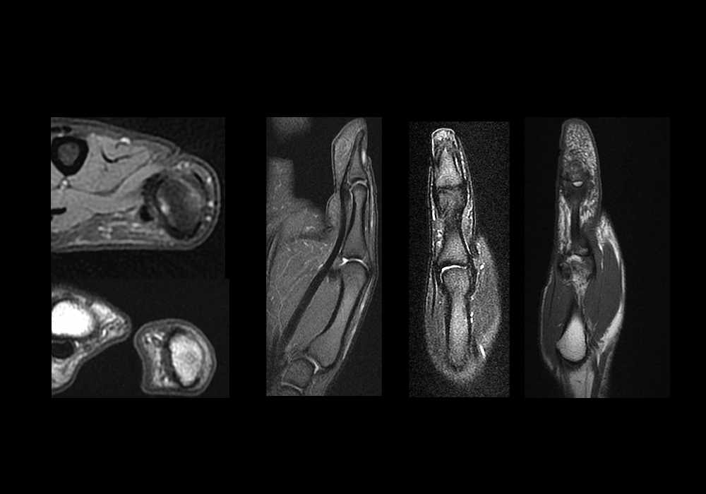 Normal MRI of the Thumb