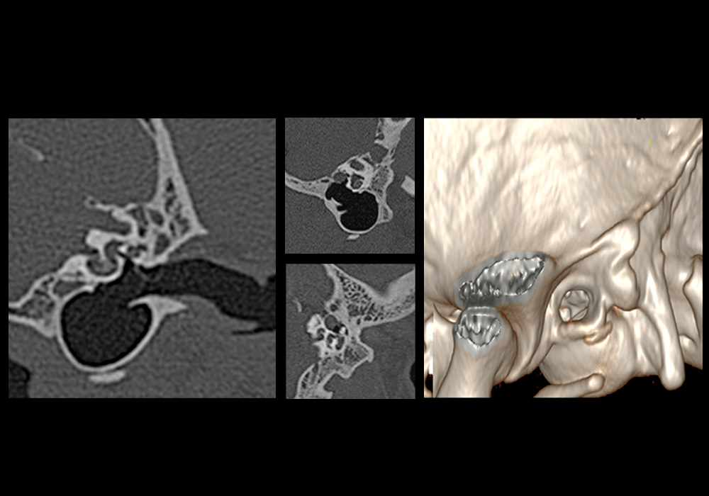 Computed tomographic anatomy of the canine temporal bone with inner and middle ear